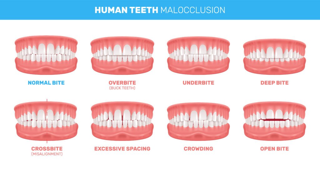 Teeth Straightening treatments for Malocclusions