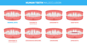 Teeth Straightening treatments for Malocclusions