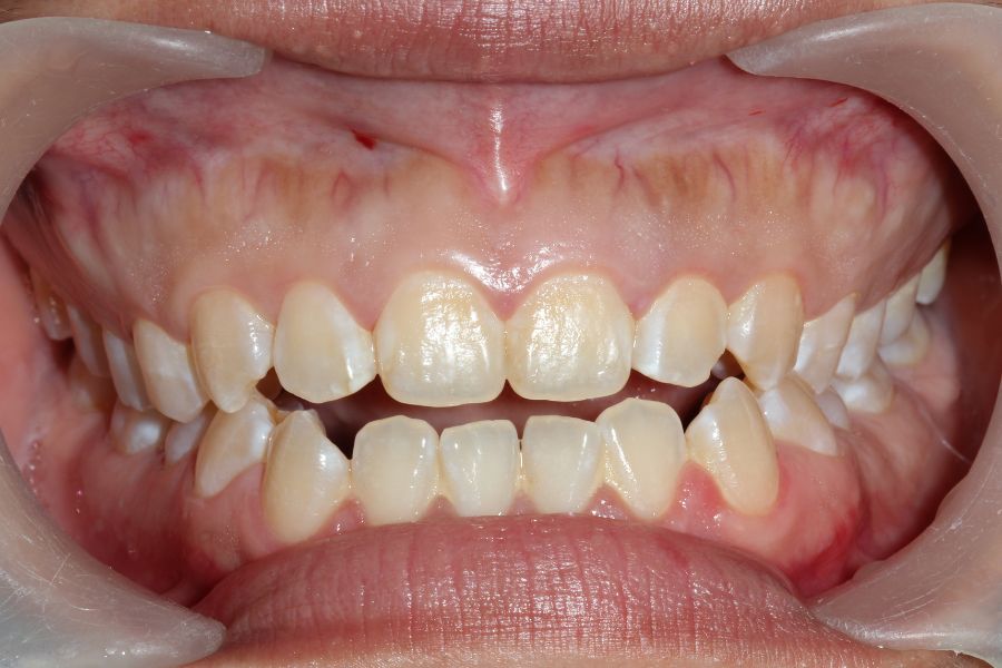 Clear Aligners for Open Bite