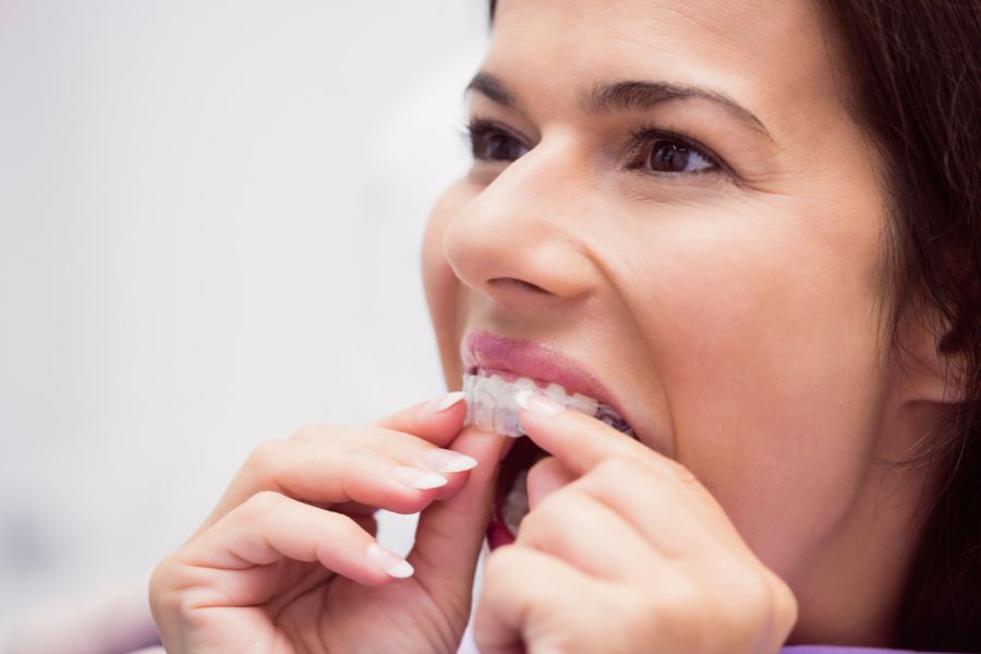 Perfecting Your Smile Focusing on Upper Teeth with Clear Aligner Solutions