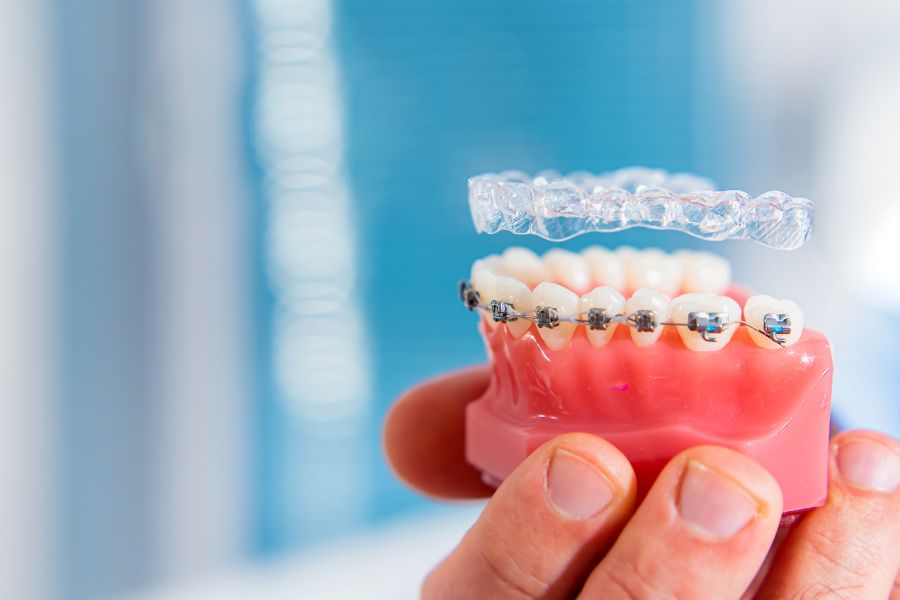 Choose between Clear Aligners vs Metal Braces