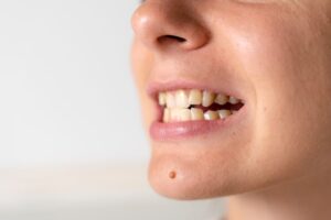 Teeth Straightening Treatment for Misalignment