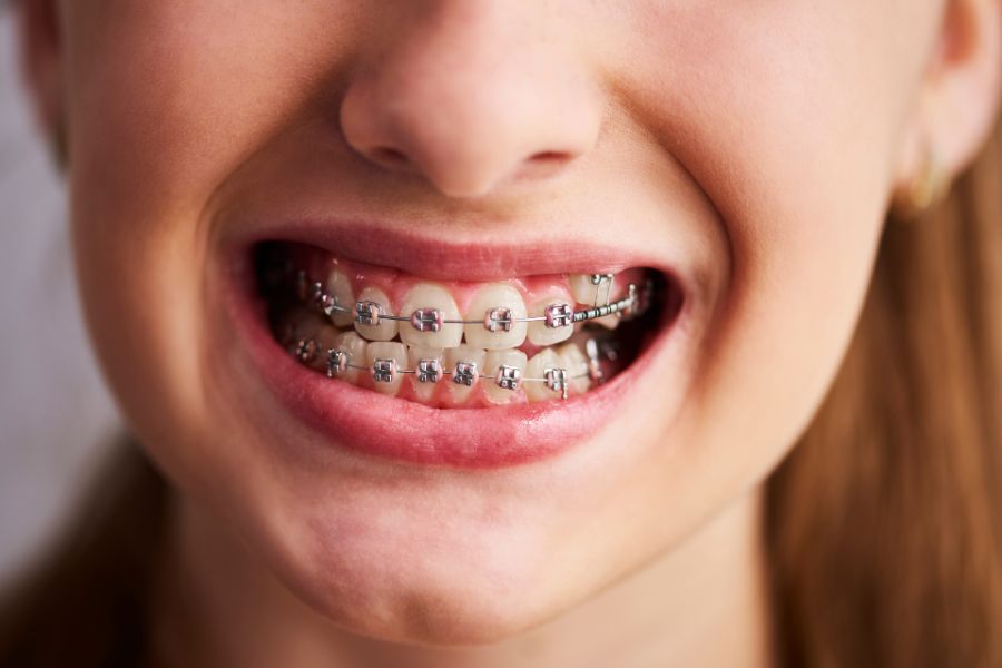 Braces correct Malocclusions