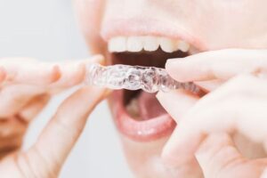 Teeth Whitening Effectiveness