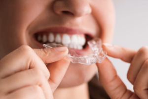 Strayt Clear Aligners Review